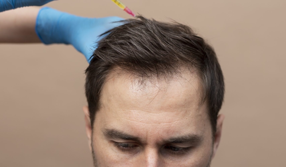 Hair Loss Treatment through Functional Medicines